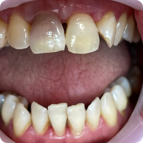Endo fogfehérítés