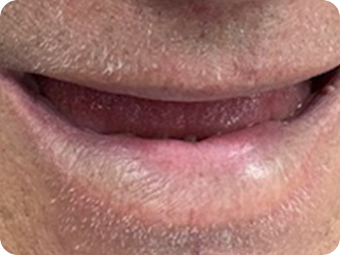 Felül All-on-4, alul csavarozható hídpótlás (Toronto Bridge)