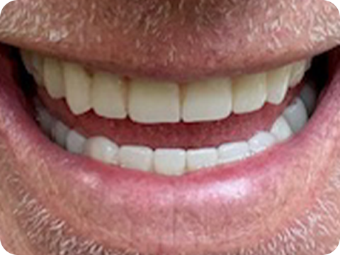 Felül All-on-4, alul csavarozható hídpótlás (Toronto Bridge)