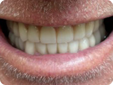 Felül All-on-4, alul csavarozható hídpótlás (Toronto Bridge)