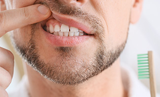 Foginygyulladás (gingivitis)