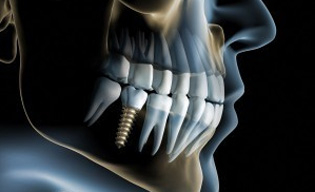 Implantátum - a hosszú távú megoldás